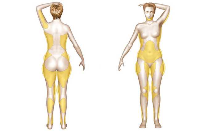 Zones du corps pouvant être traitées par liposuccion