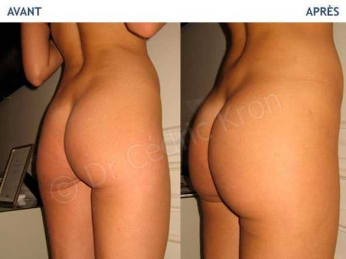 Before - After buttock plastic surgery using lipostructure