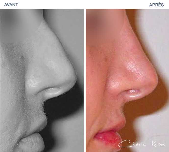 Before and after result of a plastic surgery  to remove a lump on the nose