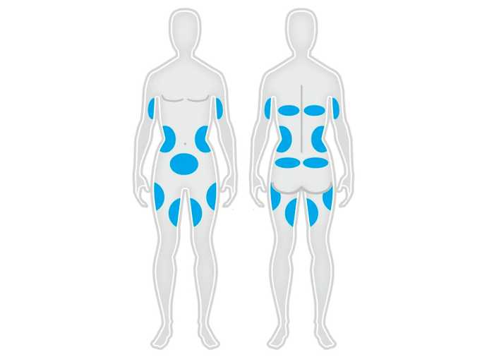 Body areas that can be treated with Coolsculpting