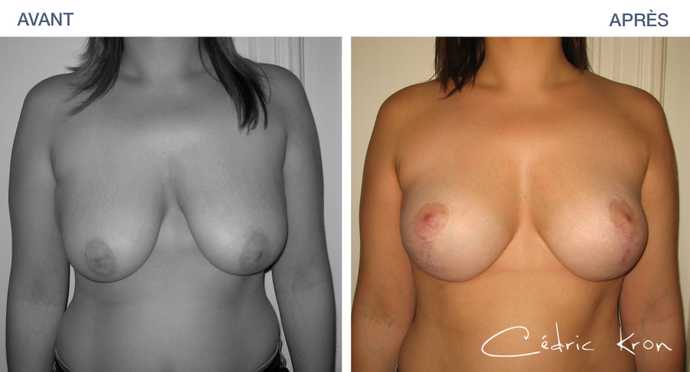 Resultat of a breast lift in before-and-after pictures