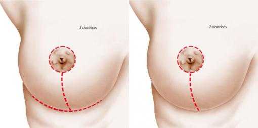 Position des cicatrices induites par une chirurgie de réduction mammaire