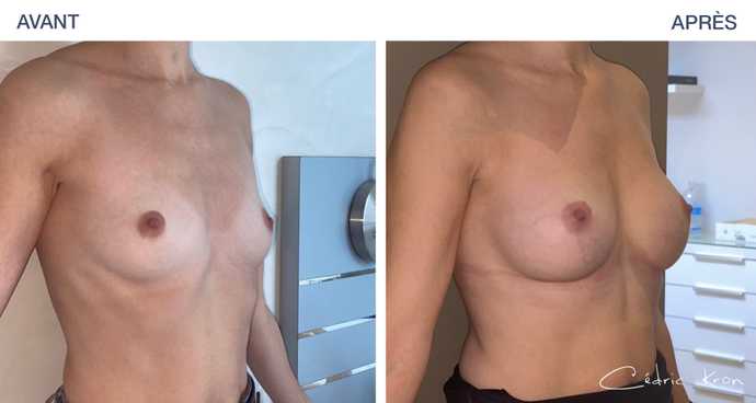 Résultat avant - après d'une augmentation mammaire par protheses ergonomix