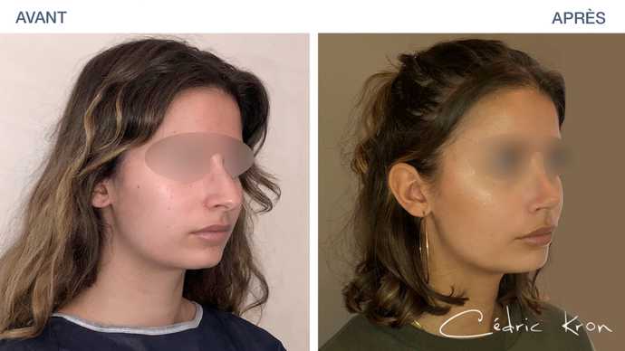 Result obtained after a rhinoplasty procedure on a 20-year-old woman