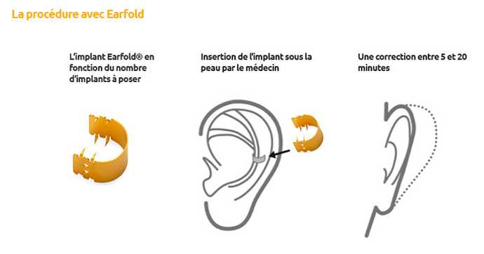 Procédure de pose d'implants earFold pour les patients souffrant d'oreilles décollées