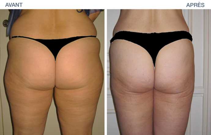 Result in before and after pictures of a liposuction of the buttock and thighs